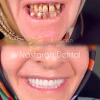 ایمپلنت دندان ۴/۹۰۰ کامپوزیت ۲/۵۰۰میلیون