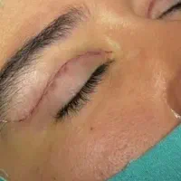 جشنواره تابستانی بلفاروپلاستی،ساکشن غبغب،سابرولیفت
