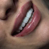لمینت تخصصی دندان فقط ۱۰ تومن
