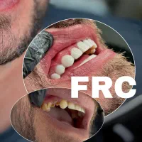 جایگزین ایمپلنت frc