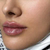 فیلر لب توسط پزشک در مطب