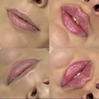 ژل و بوتاکس و آنزیم لب با قیمت قبل تزریق توسط پزشک
