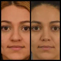 فرم دهی بینی در ۲۰ روز