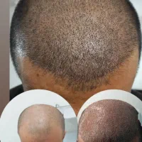 عمل بینی ساکشن کاشت مو غبغب ژل بوتاکس