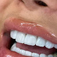 جشنواره ویژه کامپوزیت دندان لمینت روکش|خدمات آرایشگری و زیبایی|تهران, نارمک جنوبی|دیوار
