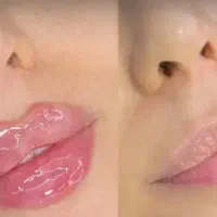 ژل بوتاکس در رزن