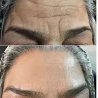 جدیدترین روش جوانسازی صورت