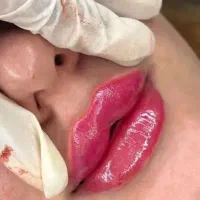 تخفیفات ژل و بوتاکس ۱ تومن