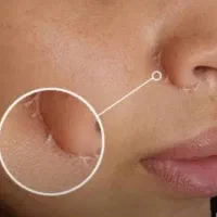 کرم ترمیم کننده جای بخیه کنار بینی جای بخیه زایمان
