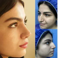 جراحی بینی ویژه مراجعین شهر میانه/درتهران/۴۲میلیون