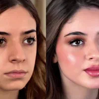 فیلرلب،ژل،چونه،پی ارپی،جوانساز