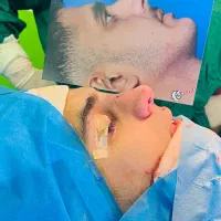 عمل جراحی بینی بدون تامپون در رشت
