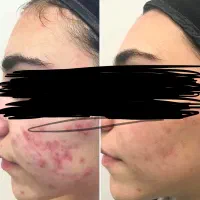 ازبین بردن جوش صورت تضمینی