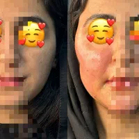 جشنواره تکرار نشدنی تزریق چربی