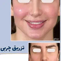 چک یا طلا فول فیس فقط ۱۵م/بوتاکس/ژل لب لیفت شقیقه