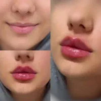 بوتاکس فیلر آمپول لاغری پیرسینگ میکرودرمال