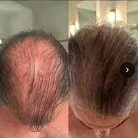 رویش انفجاری مو و قطع ریزش مو