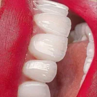 کامپوزیت دندان از ۵م عصب کشی  ایمپلنت. دندانپزشکی