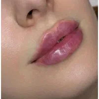 تخفیف استثنایی ژل لب،بوتاکس توسط پزشک