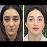 ژل لب و مادلینگ صورت و بوتاکس(فقط هزینه مواد) اپال