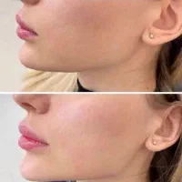 تزریق فیلر و بوتاکس