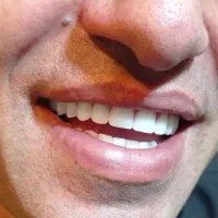 دندان مصنوعی بدن کام طرح لمینتی