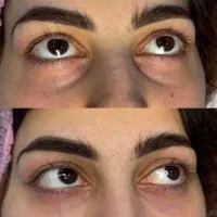 ژل و بوتاکس