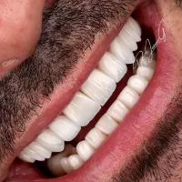 دندان مصنوعی تحویل۵ساعته(شهرمحلات) کامپوزیت دندان