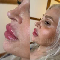 ژل*بوتاکس*آراف*لیزر