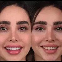 ایمپلنت لمینت عصبکشی و روکش با شرایط اقساطی