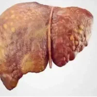 رفع جوش های صورت و بدن با مصفی خون