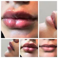 جشنواره تخفیف کاشت نخ کلاژن،ژل ،فیلرصورت وبدن