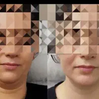 مدل برای تزریق فیلر