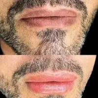 رفع تیرگی لب آقایون