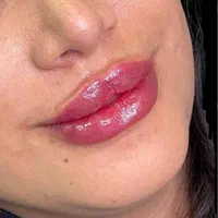 اموزش ژل و بوتاکس و لیفت نخ