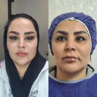 جراحی افتادگی پلک فقط ۷.۹۹۰ تومن