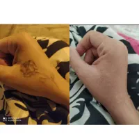 نیازمند مدل ریمو درمانی تتوی صورت