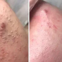 پاکسازی پوست و خالبرداری