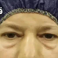 افتادگی پلک ( آبادان ، خرمشهر ، اهواز)