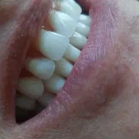 کشیدن و دندان مصنوعی ثابت بدون لقی در محل شما