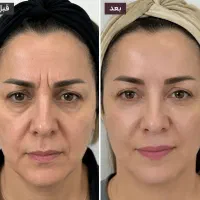 فیلر بوتاکس مزوژل هایف مزوتراپی جوانساز
