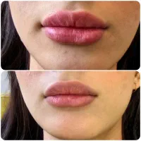 تخفیف خدمات زیبایی،بوتاکس وفیلر لب وصورت توسط پزشک