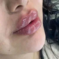 ژل،بوتاکس،بوتاکس زیر بغل،پیرسینگ بدن