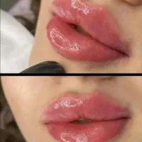 تزریق ژل و بوتاکس ومزو  900درکلینیک
