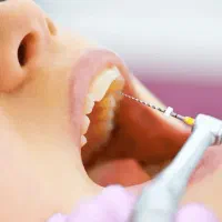 خدمات دندانپزشکی با قیمت مناسب/عصبکشی از یک میلیون
