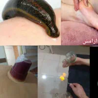 زالودرمانی/حجامت/ماساژدرمانی/بادکش سرد و گرم