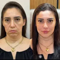 جشنواره تزریق ژل و بوتاکس درکلینیک مشاوره رایگان