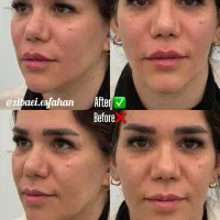 مدل فقط هزینه مواد تزریق ژل توسط پزشک