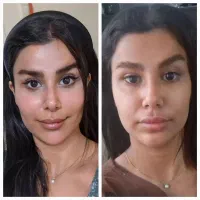 مدل تزریق ژل و بوتاکس