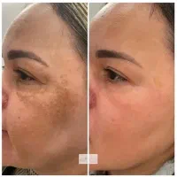ضدلک ایتالیایی